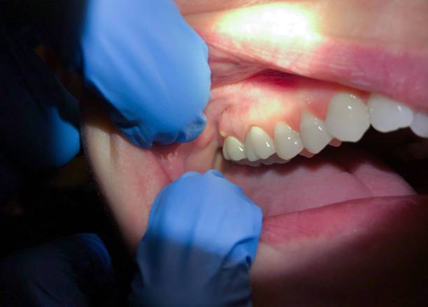 Best Emergency Treatment for Oral Infections in Judsonia, AR